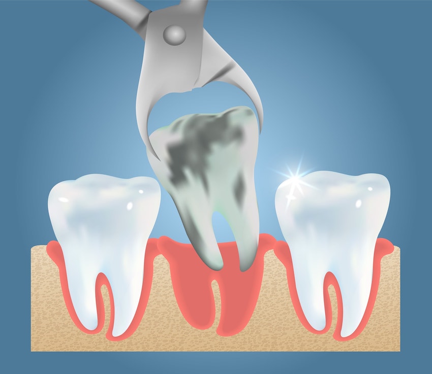broken wisdom tooth extraction cost